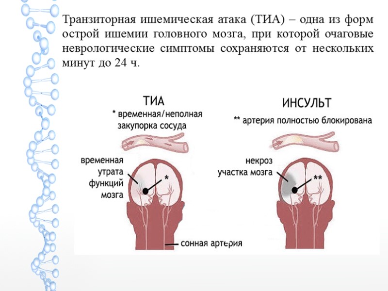 Транзиторная ишемическая атака (ТИА) – одна из форм острой ишемии головного мозга, при которой